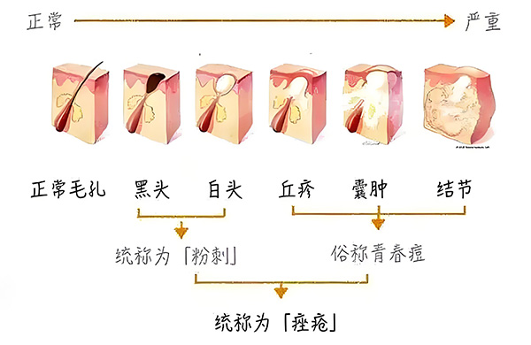黑頭怎么去除最有效？去除黑頭最有效的方法