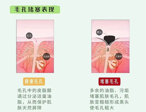 毛孔堵塞的表現 毛孔堵塞怎么疏通毛孔?