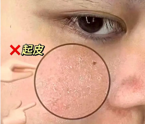 臉上起皮 化完妝后臉上起皮怎么補(bǔ)救?