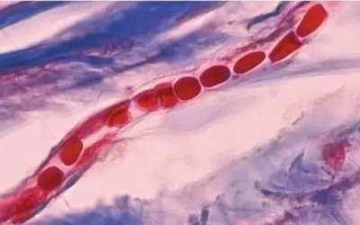 紅血絲是什么原因?qū)е碌?？紅血絲形成的原因！