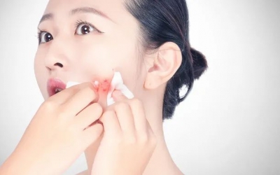 如何預(yù)防粉刺的發(fā)生和痤瘡的形成？