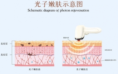 光子嫩膚術(shù)前注意事項有哪些？
