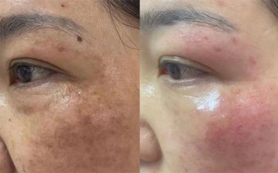 祛斑后為什么會反黑？祛斑后會反黑是什么原因？